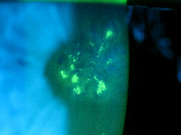 HSV keratitis 3-25-2010 fluorescein pat.
