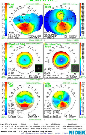 topography and aberrometry of pseudocone: corneal molding caused by improper RGP lens fit.