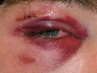 (1 of 3) lid contusion one day after baseball impact