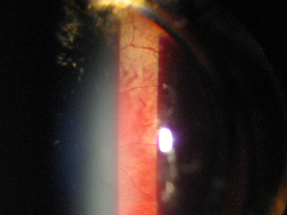 (2 of 3) Commotio Retinae one day after baseball impact