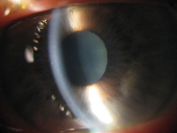 left eye steamy cornea, IOP~80