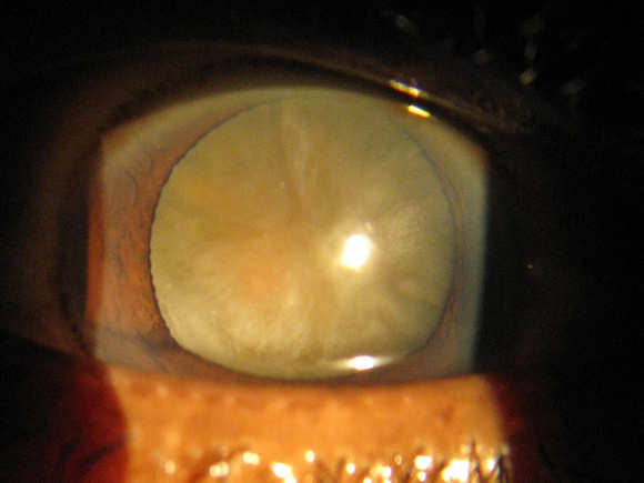 patient asked: "Do you think that cataract REALLY needs to come out?"
