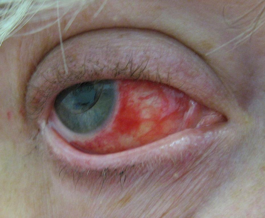 conj laceration from dog STEPPING on eye