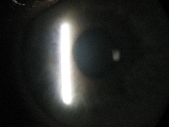 left eye steamy cornea IOP~80