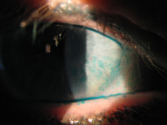 lissamine green corneal stain