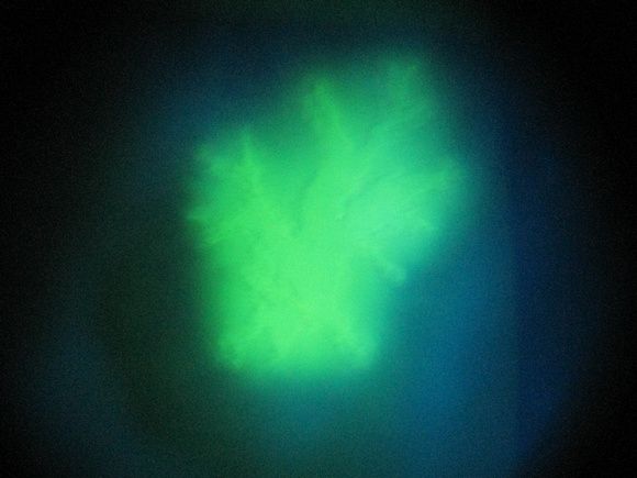 HSV keratitis 3-22-2010, fluorescein pat