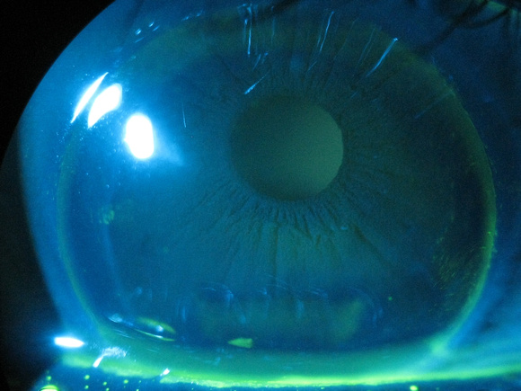 imprinted cornea from extremely steep RGP fit