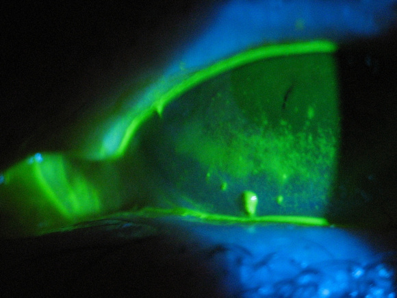 filamentary keratitis, severe dry eye